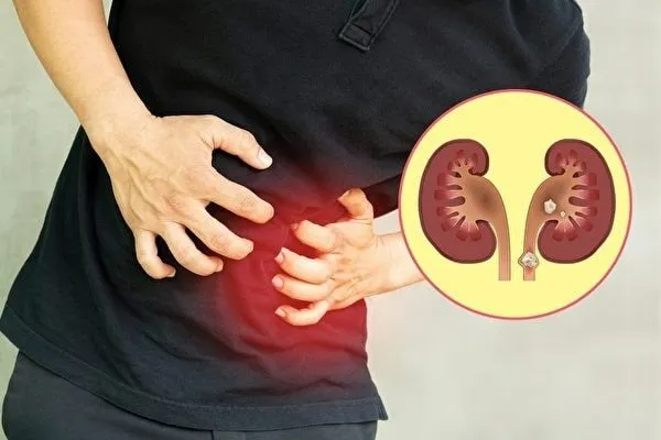 bị sỏi thận có uống được xạ đen không